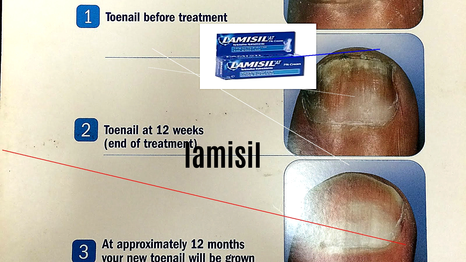 Lamisil 250 mg prix